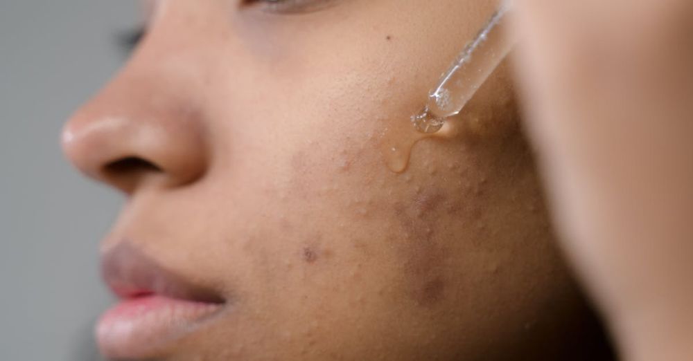 Acne Treatments - Close-up side view of a woman applying serum to her skin in a studio setting.