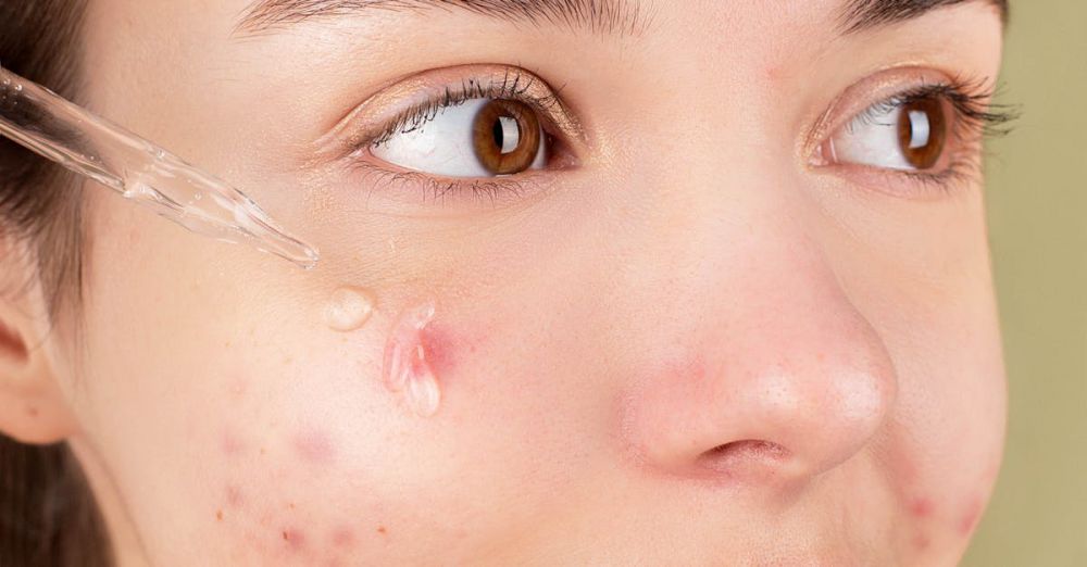 Acne Treatments - Close-up of a young woman applying serum on her face for acne treatment and skincare routine.