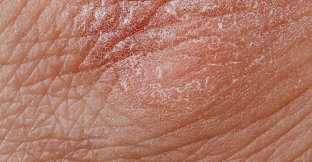 Skin Peels - Detailed image highlighting dry, flaky skin texture for dermatological study.