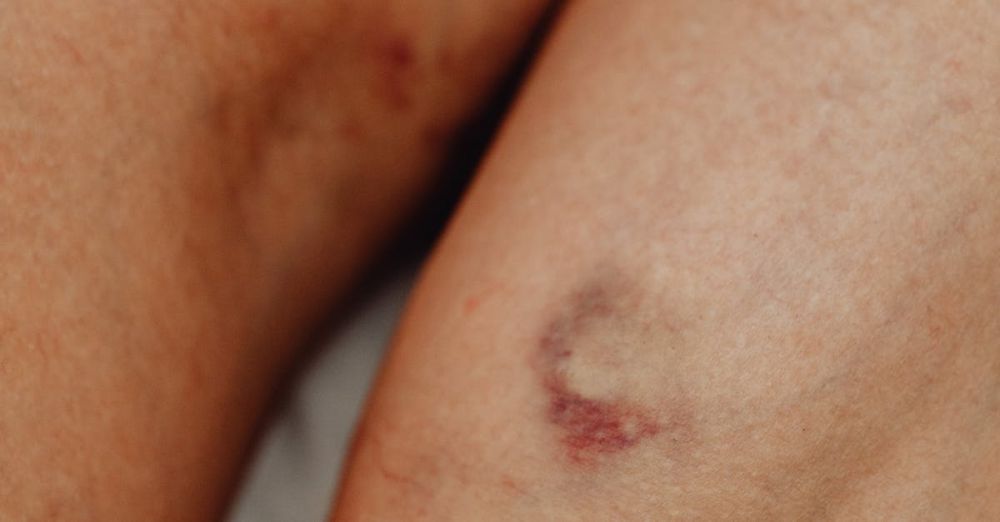 Injuries - Detailed close-up of human skin showing bruises and imperfections, highlighting natural texture.