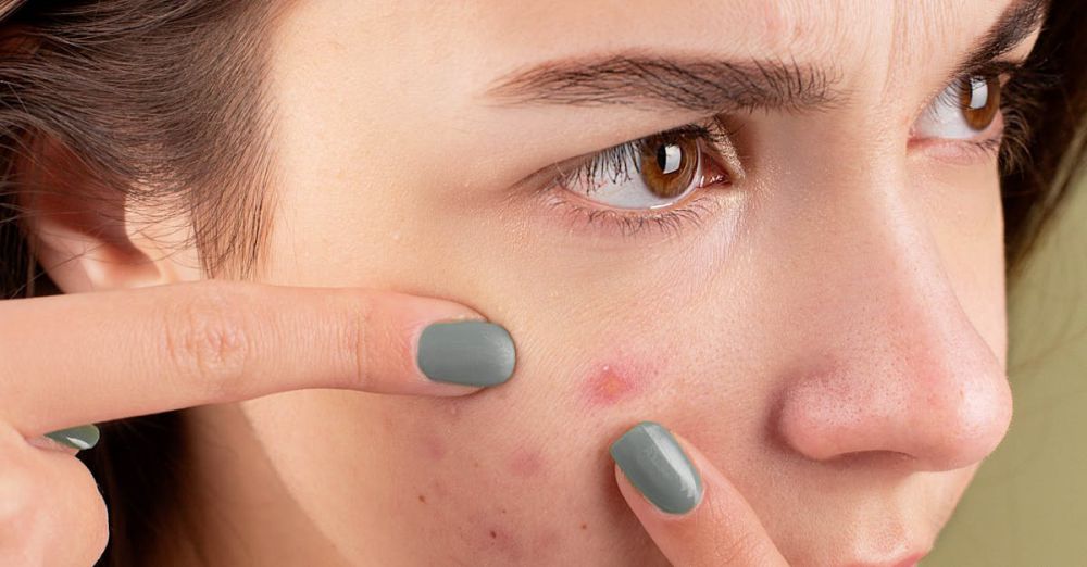 Acne Treatments - Close-up of a young woman treating her acne-prone skin.